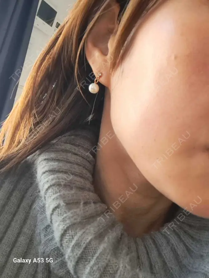 マイクロボトックス 日本美容・医療クリニック 六本木院 DAY 0 メイン用