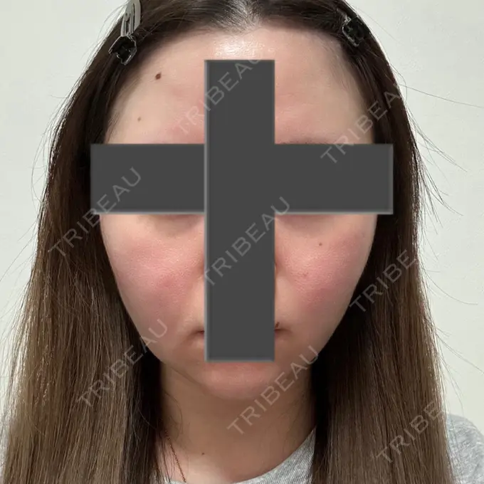 脂肪吸引（顔） / ジョールファット除去 / ヒアルロン酸注入（あご） / ボトックス（エラ・小顔） Otus Clinic 【オータスクリニック】 DAY 62 メイン用