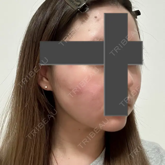 脂肪吸引（顔） / ジョールファット除去 / ヒアルロン酸注入（あご） / ボトックス（エラ・小顔） Otus Clinic 【オータスクリニック】 DAY 62 メイン用