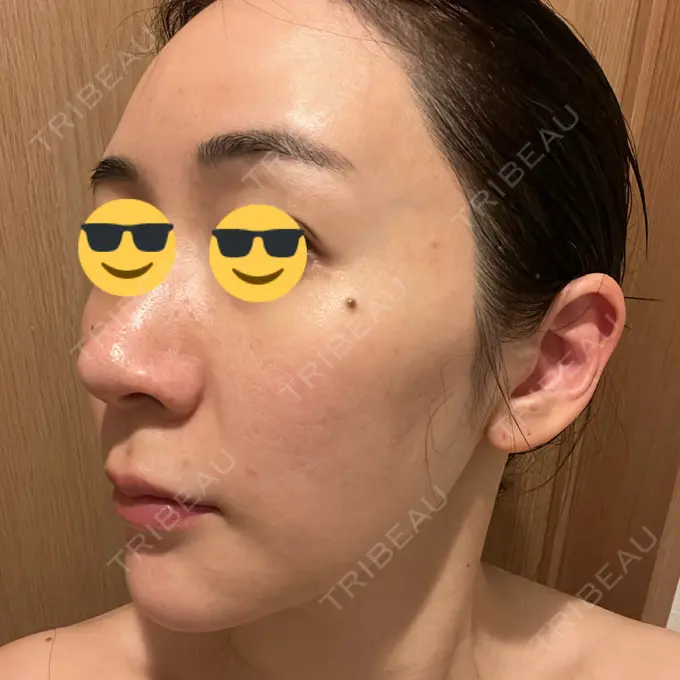 ニードルRF（ポテンツァなど） オラクル美容皮膚科 東京新宿院 DAY 10 メイン用