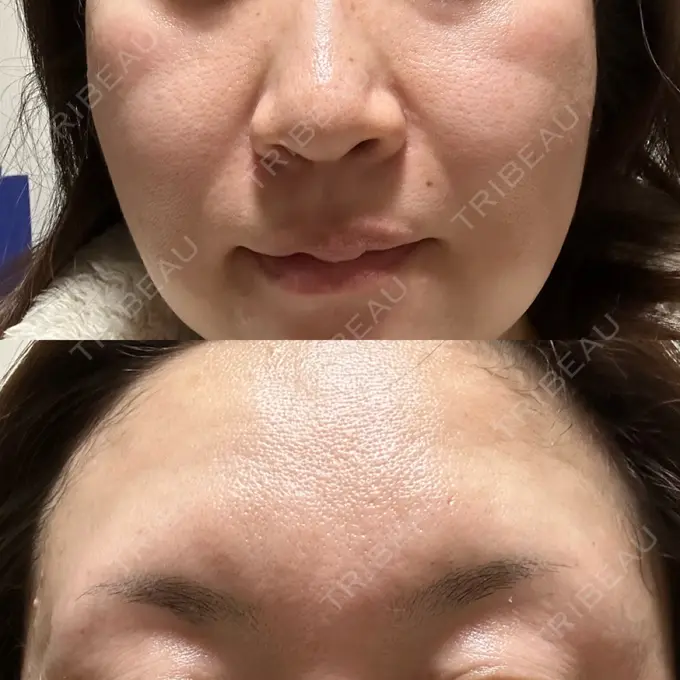 ピーリング（ニキビ・毛穴） 豊洲内科・糖尿病 / 形成・美容外科クリニック DAY 0 メイン用