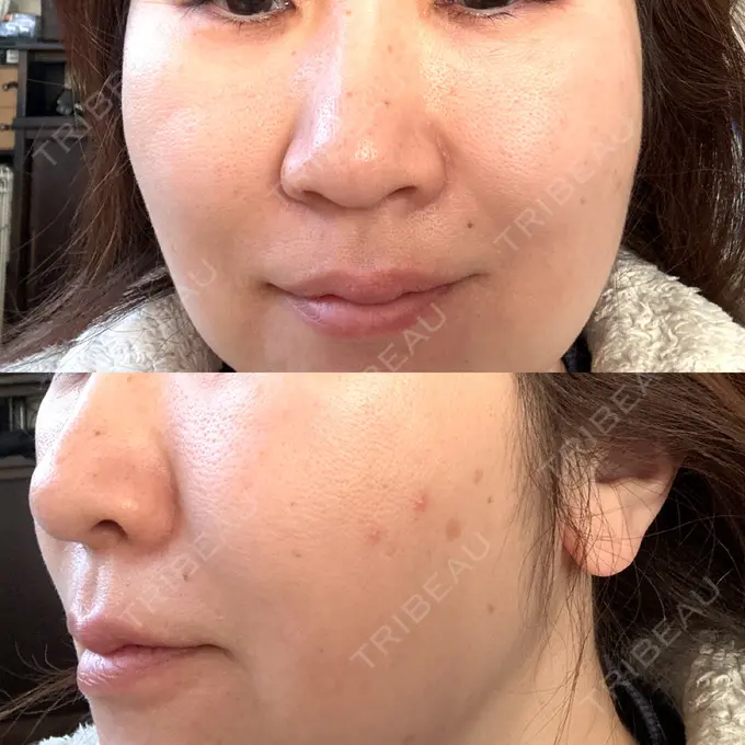 ピーリング（ニキビ・毛穴） 豊洲内科・糖尿病 / 形成・美容外科クリニック DAY 1 メイン用