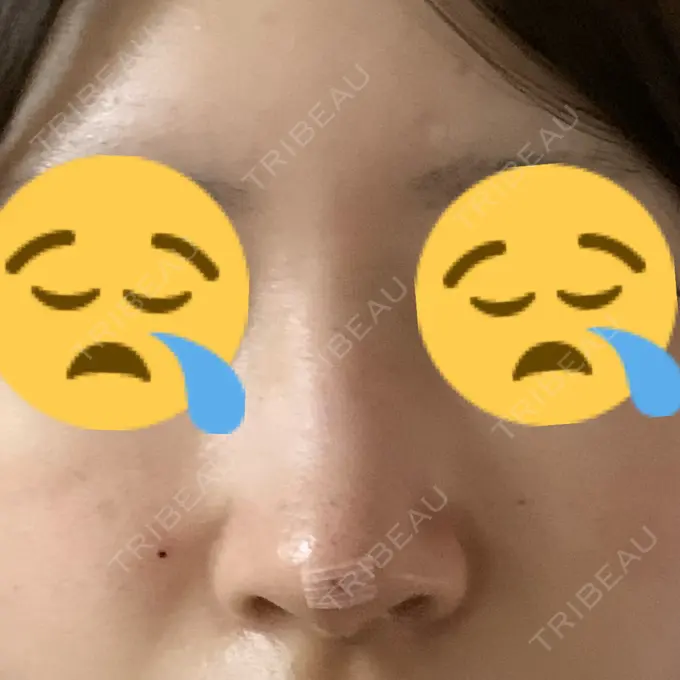 鼻中隔延長（非切開） TCB東京中央美容外科 八王子院 DAY 1 メイン用