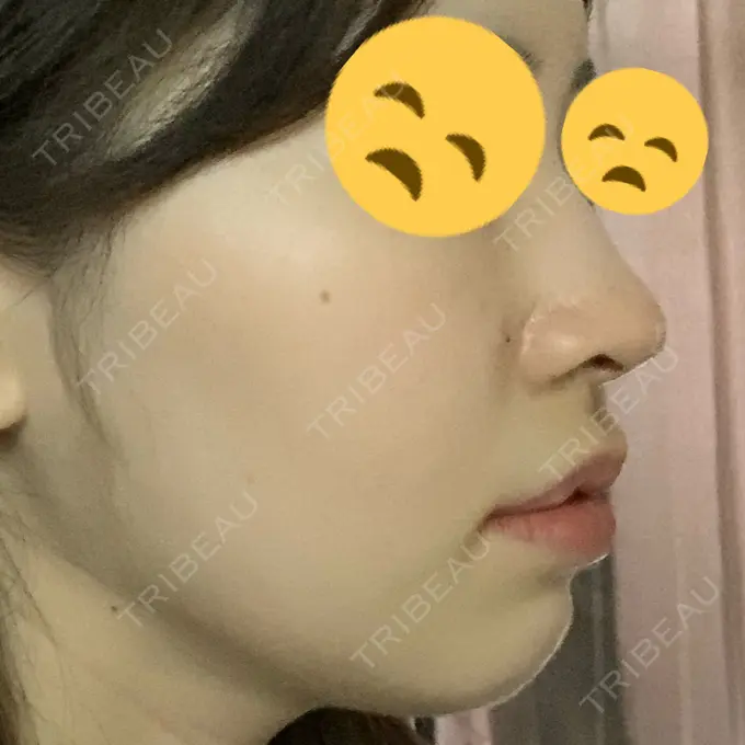 鼻中隔延長（非切開） TCB東京中央美容外科 八王子院 DAY 1 メイン用