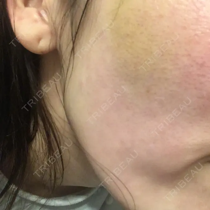 水光注射（ハリ・美肌） / 脂肪溶解注射（顔） / ハイフ（顔） チョンダムジュエンクリニック DAY 11 メイン用