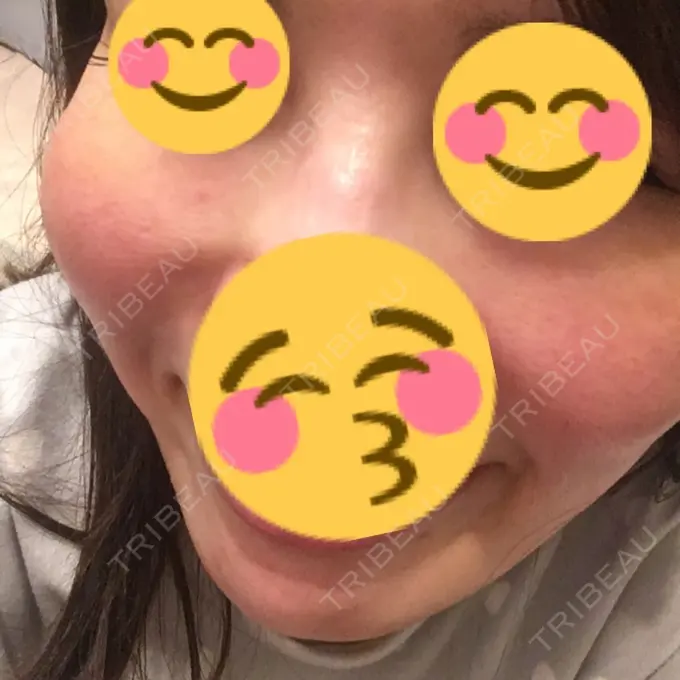 水光注射（ハリ・美肌） / 脂肪溶解注射（顔） / ハイフ（顔） チョンダムジュエンクリニック DAY 11 メイン用