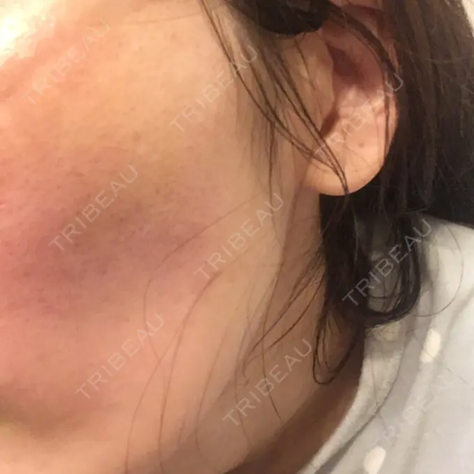 水光注射（ハリ・美肌） / 脂肪溶解注射（顔） / ハイフ（顔） チョンダムジュエンクリニック DAY 11 メイン用