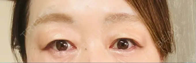 眉下切開 ルーチェクリニック 銀座院 DAY 0 メイン用