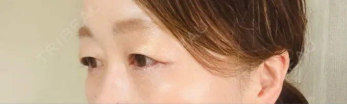 眉下切開 ルーチェクリニック 銀座院 DAY 0 メイン用