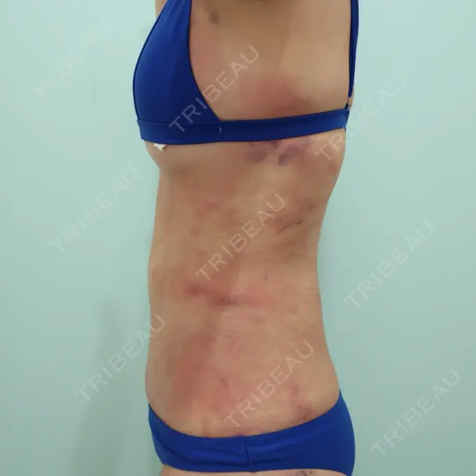 脂肪吸引（お腹） / 脂肪吸引（背中） WOM CLINIC GINZA （ワム クリニック ギンザ） DAY 55 メイン用