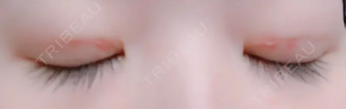 二重埋没 湘南美容クリニック 京都院 DAY 4 メイン用