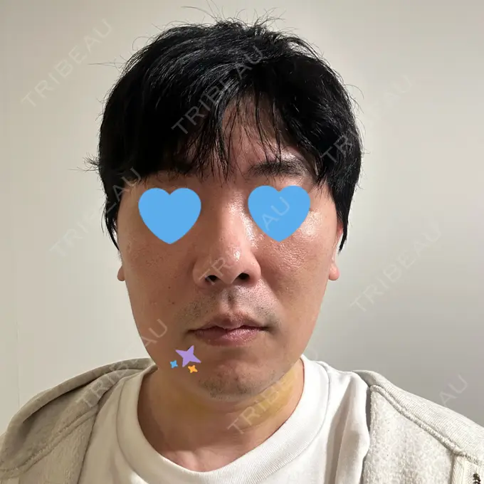 糸リフト / バッカルファット除去 / 脂肪吸引（顔） / メーラーファット除去 / ボトックス（エラ・小顔） RIVER CLINIC（リバークリニック） DAY 11 メイン用