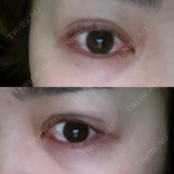 二重埋没 Brandnew Beauty Clinic AFTER メイン用