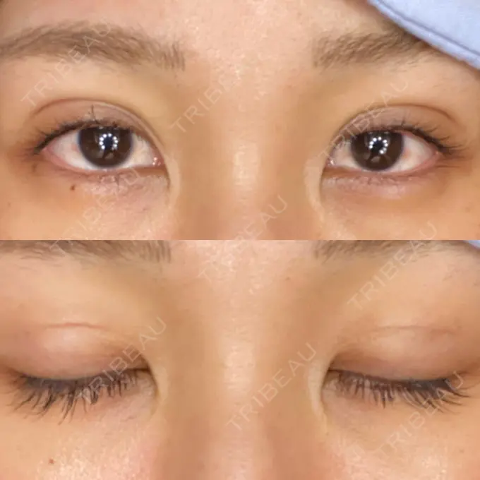 二重埋没 城本クリニック 大阪院 DAY 7 メイン用