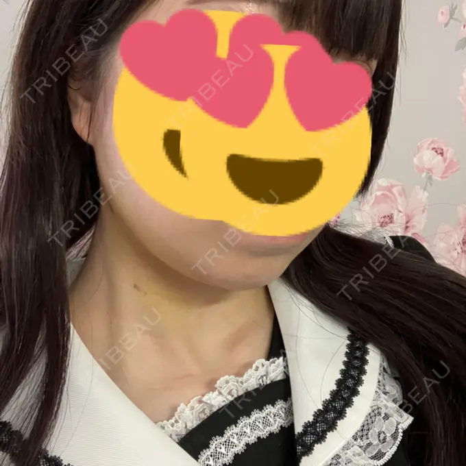 糸リフト / バッカルファット除去 / 脂肪吸引（顔） RIVER CLINIC（リバークリニック） DAY 5 メイン用