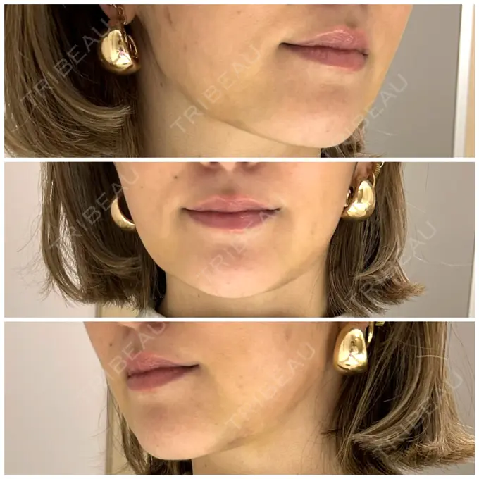 ジョールファット除去 / 脂肪吸引注射（顔） ziz CLINIC DAY 6 メイン用