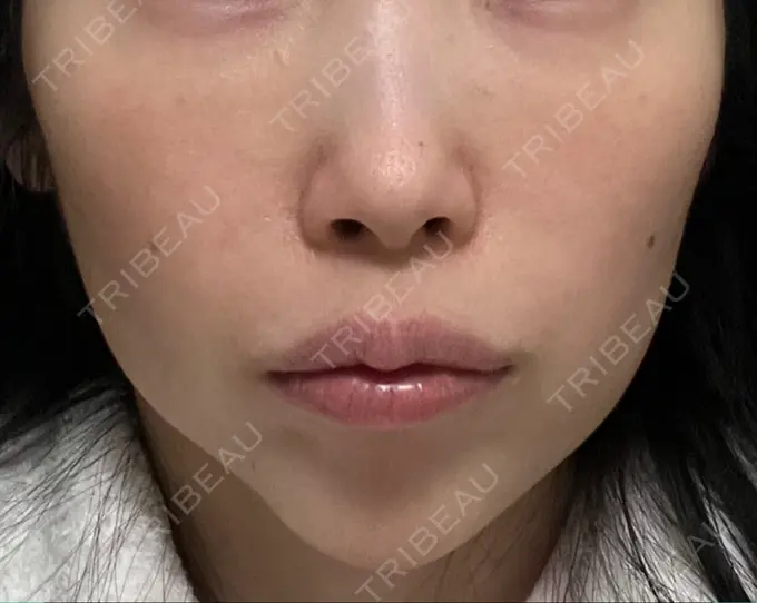 ハイフ（顔） 椿クリニック 心斎橋院 DAY 18 メイン用