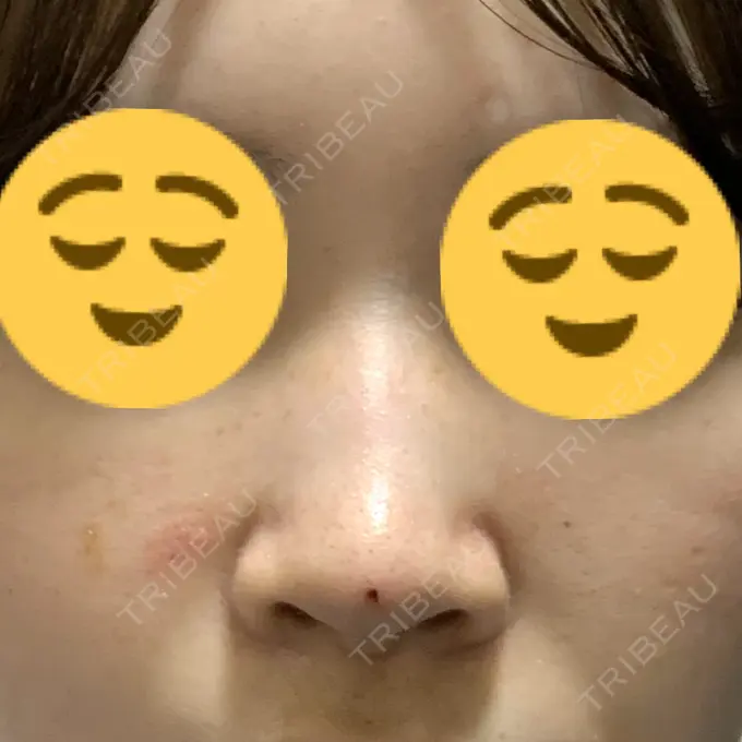 鼻中隔延長（非切開） TCB東京中央美容外科 八王子院 AFTER メイン用