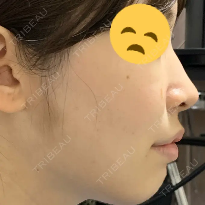 鼻中隔延長（非切開） TCB東京中央美容外科 八王子院 DAY 2 メイン用