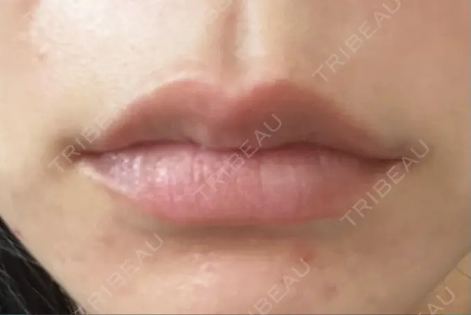 ヒアルロン酸注入（唇） 湘南美容クリニック 藤沢院 AFTER メイン用