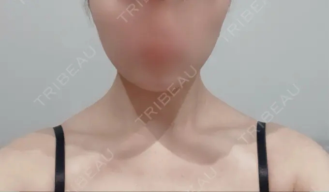 ボトックス（エラ・小顔） / ボトックス（肩） L‘amour clinic Tokyo【ラムールクリニック東京】 AFTER メイン用