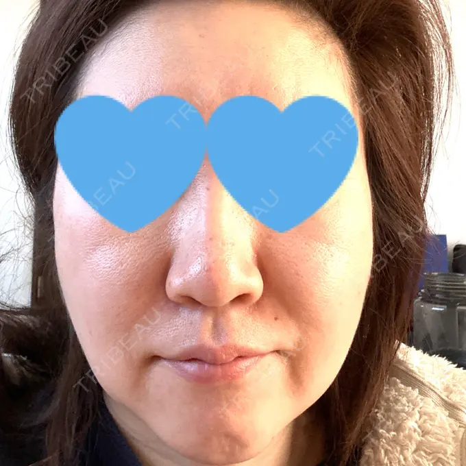 ピーリング（ニキビ・毛穴） 豊洲内科・糖尿病 / 形成・美容外科クリニック AFTER メイン用