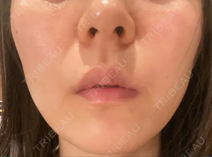 ハイフ（顔） / イオン導入 メディアージュクリニック 青山院 AFTER メイン用