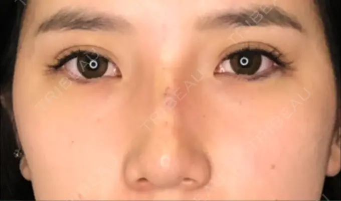 ヒアルロン酸注入（涙袋） / ヒアルロン酸注入（鼻） TCB東京中央美容外科 中野院 AFTER メイン用