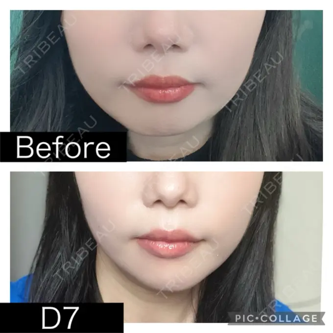 脂肪溶解注射（顔） SK新宿歌舞伎町美容外科・歯科 DAY 7 メイン用