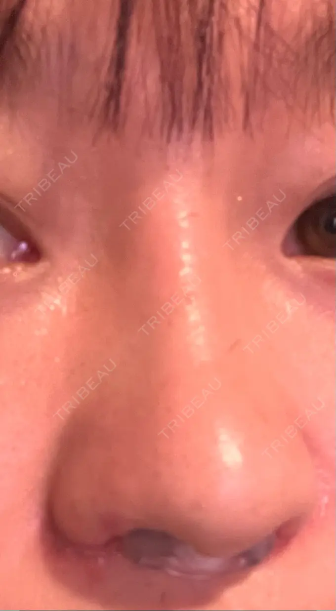 隆鼻術 / 鼻尖形成（切開） / 小鼻縮小（切開） / 軟骨移植 グローバルビューティークリニック 銀座院 DAY 11 メイン用