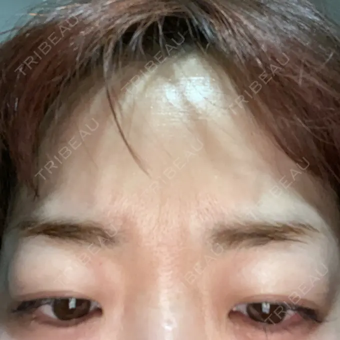 ボトックス（眉間） / その他（鼻） ルラ美容クリニック 大阪本院 AFTER メイン用