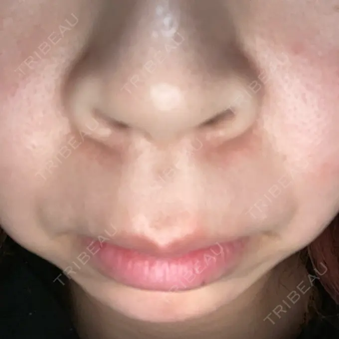 ボトックス（眉間） / その他（鼻） ルラ美容クリニック 大阪本院 DAY 0 メイン用