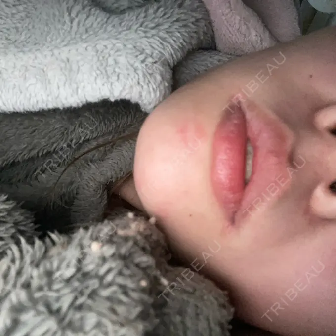 鼻中隔延長（非切開） / ボトックス（エラ・小顔） TCB東京中央美容外科 町田院 DAY 29 メイン用