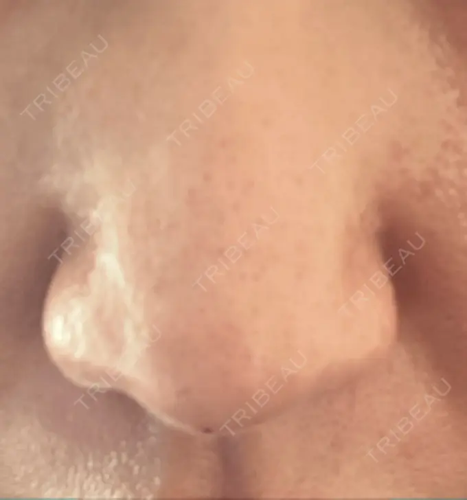 鼻尖形成（切開） / 鼻中隔延長（非切開） ASTRA BEAUTY CLINIC DAY 4 メイン用