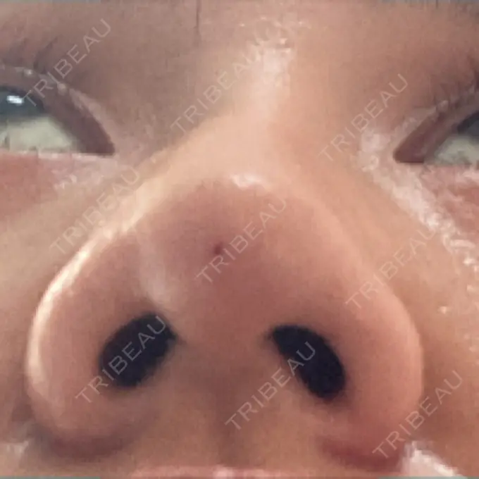 鼻尖形成（切開） / 鼻中隔延長（非切開） ASTRA BEAUTY CLINIC DAY 4 メイン用