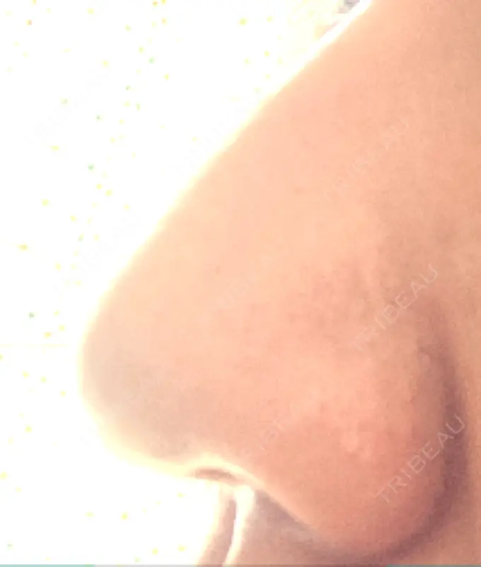 鼻尖形成（切開） / 鼻中隔延長（非切開） ASTRA BEAUTY CLINIC DAY 4 メイン用