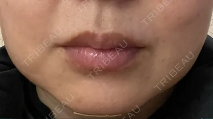 バッカルファット除去 / 脂肪吸引（顔） 湘南美容クリニック 博多院 DAY 3 メイン用