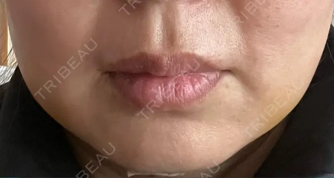 バッカルファット除去 / 脂肪吸引（顔） 湘南美容クリニック 博多院 DAY 4 メイン用