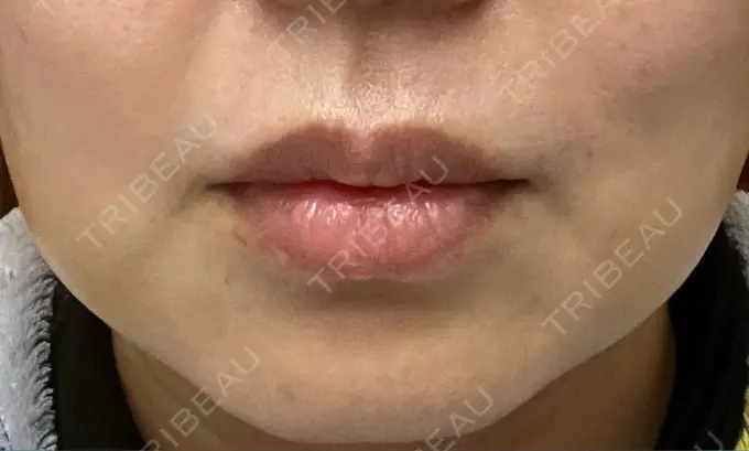 バッカルファット除去 / 脂肪吸引（顔） 湘南美容クリニック 博多院 DAY 5 メイン用