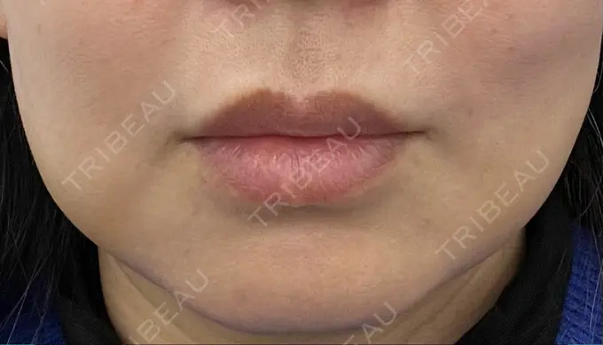 バッカルファット除去 / 脂肪吸引（顔） 湘南美容クリニック 博多院 DAY 6 メイン用