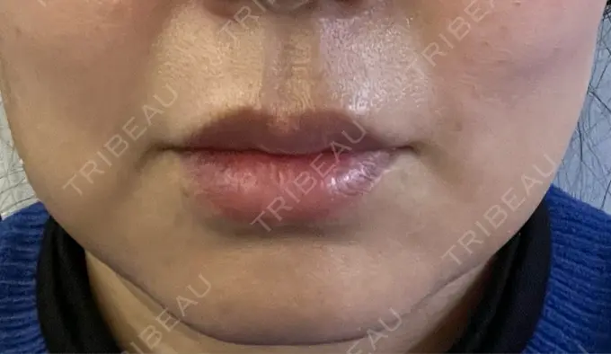 バッカルファット除去 / 脂肪吸引（顔） 湘南美容クリニック 博多院 DAY 8 メイン用