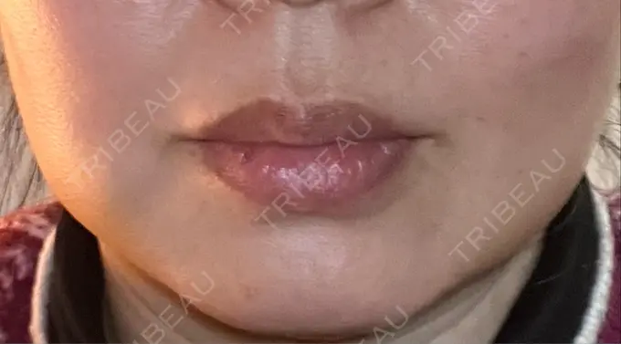 バッカルファット除去 / 脂肪吸引（顔） 湘南美容クリニック 博多院 DAY 9 メイン用