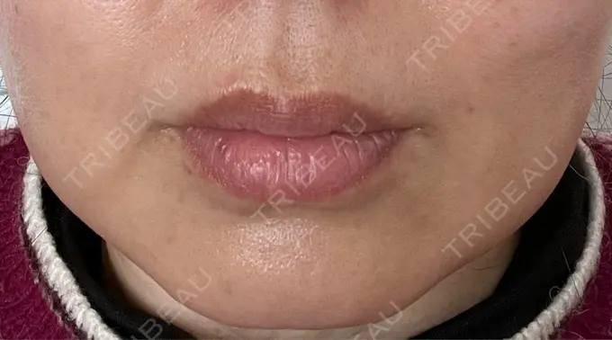 バッカルファット除去 / 脂肪吸引（顔） 湘南美容クリニック 博多院 AFTER メイン用