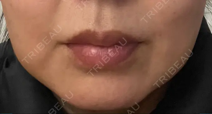 バッカルファット除去 / 脂肪吸引（顔） 湘南美容クリニック 博多院 DAY 7 メイン用