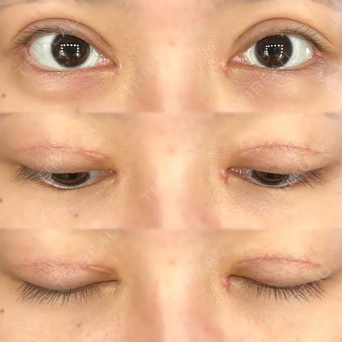 二重切開 / 目頭切開 / クマ治療 / 目尻切開 / 上まぶたたるみ取り / 下まぶたの脂肪取り / 脂肪注入（目の下） 湘南美容クリニック 大阪堺東院 DAY 46 メイン用