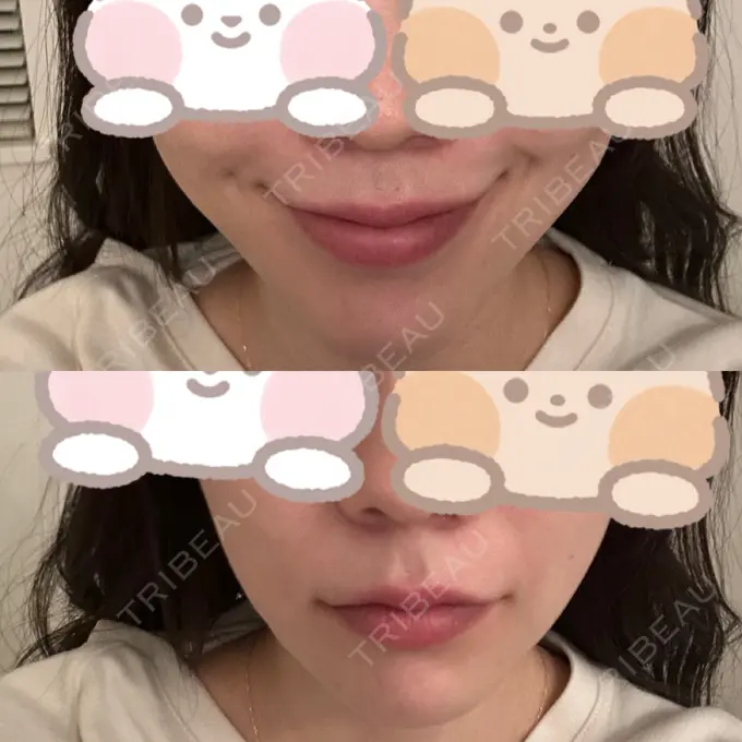 糸リフト / バッカルファット除去 RIVER CLINIC（リバークリニック） DAY 6 メイン用