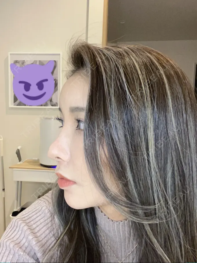 額を丸く / 脂肪注入（額） / 脂肪注入（目の下） ルーチェクリニック 銀座院 DAY 13 メイン用