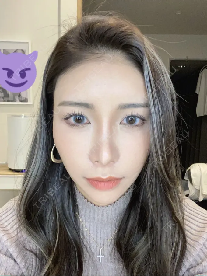 額を丸く / 脂肪注入（額） / 脂肪注入（目の下） ルーチェクリニック 銀座院 DAY 13 メイン用