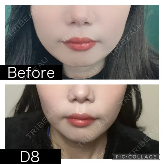 脂肪溶解注射（顔） SK新宿歌舞伎町美容外科・歯科 DAY 8 メイン用