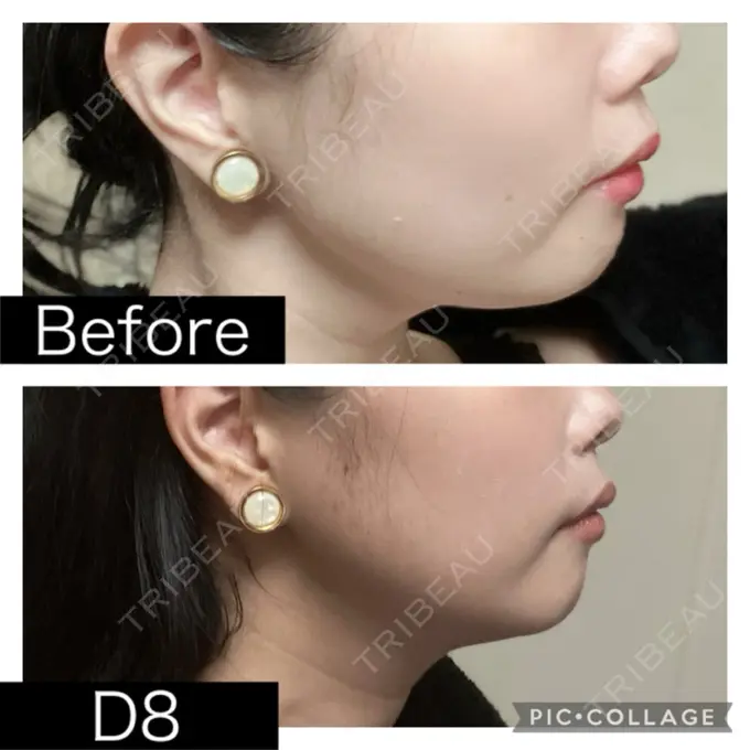 脂肪溶解注射（顔） SK新宿歌舞伎町美容外科・歯科 DAY 8 メイン用